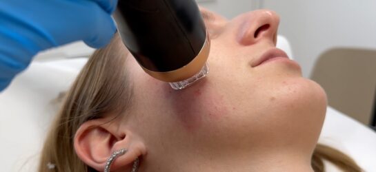 מיצוק העור: מהפכה בטיפולי אנטי-אייג'ינג Radiofrequenz Microneedling Dermacare Wien טיפולים לא פולשניים להידוק ומיצוק העור: מהפכה בטיפולי אנטי-אייג'ינג