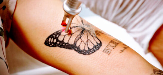 קאבר-אפ עם לייזר לכל קעקוע הסרת קעקועים בלייזר