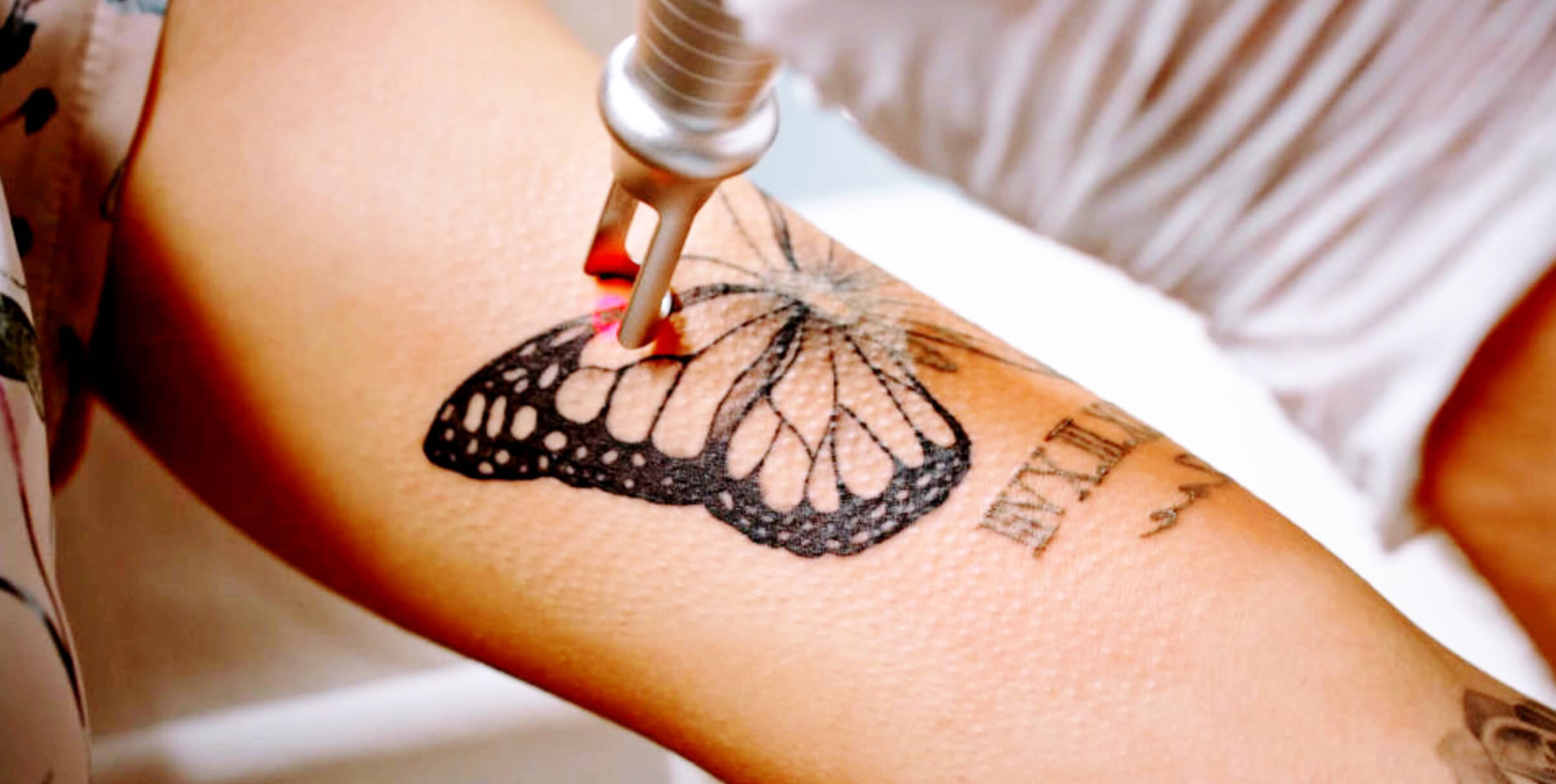 כמה טיפולי לייזר צריך לפני קאבר לקעקוע?