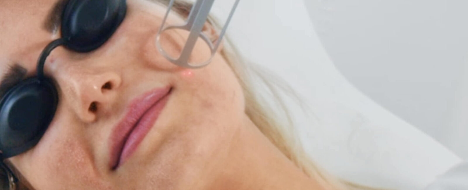 טיפול בצלקות אקנה: אילו שיטות באמת עוזרות? 