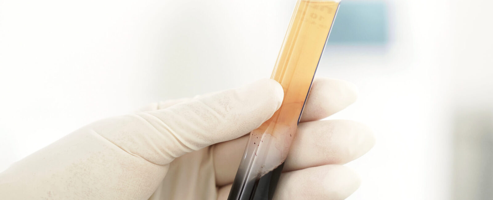 טיפול משולב לקמטים עם PRP וחומצה היאלורונית בקליניקת דרמה-קר בפתח תקווה faltenbehandlung bei dermacare faltenbehandlung mit hyaluronsaeure prp1 טיפול משולב לקמטים עם PRP וחומצה היאלורונית בקליניקת דרמה-קאר בפתח תקווה