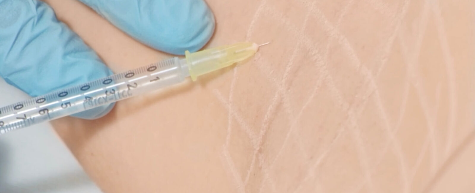 קיץ ללא כתמי זיעה: מה עוזר נגד הזעה מוגברת? achsel Botox gege Schwitzen starkes schwitzen was hilft gegen schwitzen wien frau1 קיץ ללא כתמי זיעה: מה עוזר נגד הזעה מוגברת?