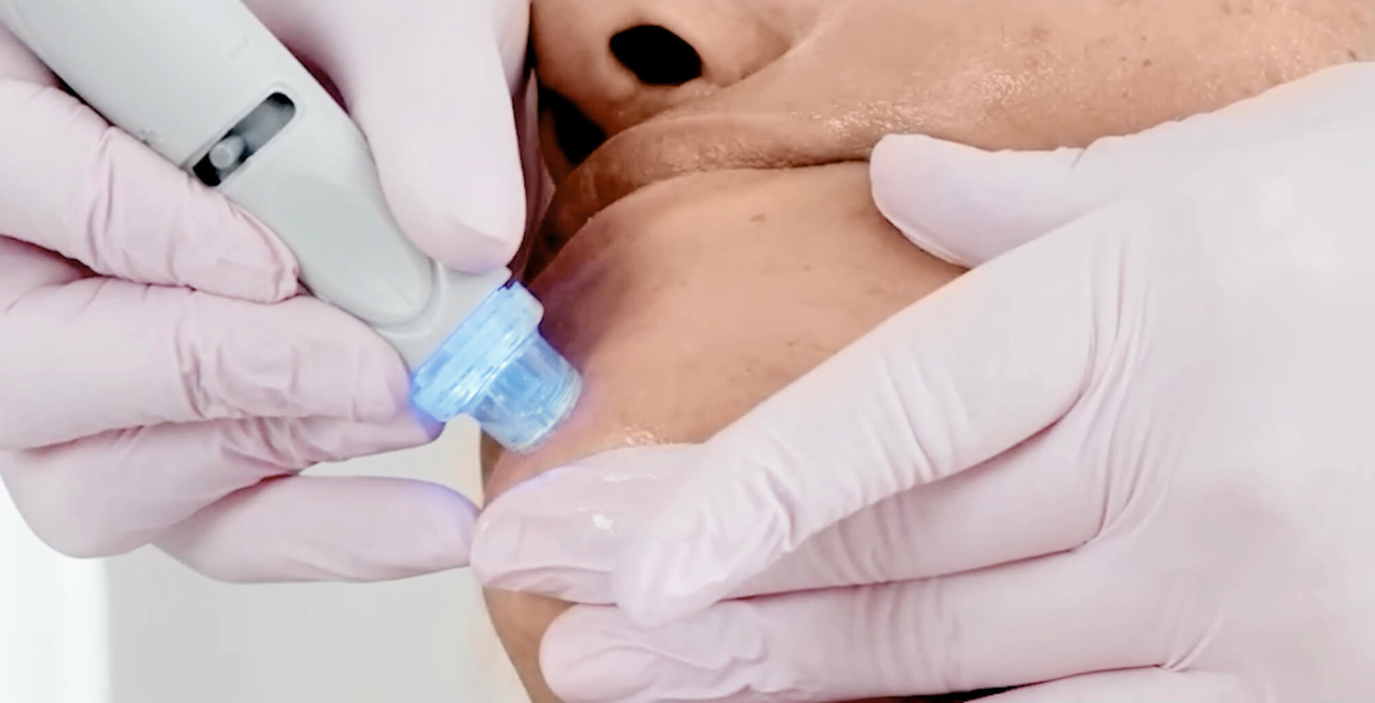 הידרופיישל: ניקוי פנים עמוק וזוהר aquafacial wien gruendliche gesichtsreinigung frau 21 הידרופיישל: ניקוי פנים עמוק וזוהר