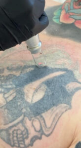 קאבר אפ לקעקוע או הסרת קעקועים בלייזר - מה עדיף? 