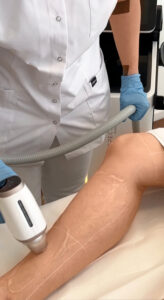 5 טיפים לרגליים חלקות ומטופחות למשך כל השנה 2 glatte beine laser haarentfernung haarfrei beine1 5 טיפים לרגליים חלקות ומטופחות למשך כל השנה