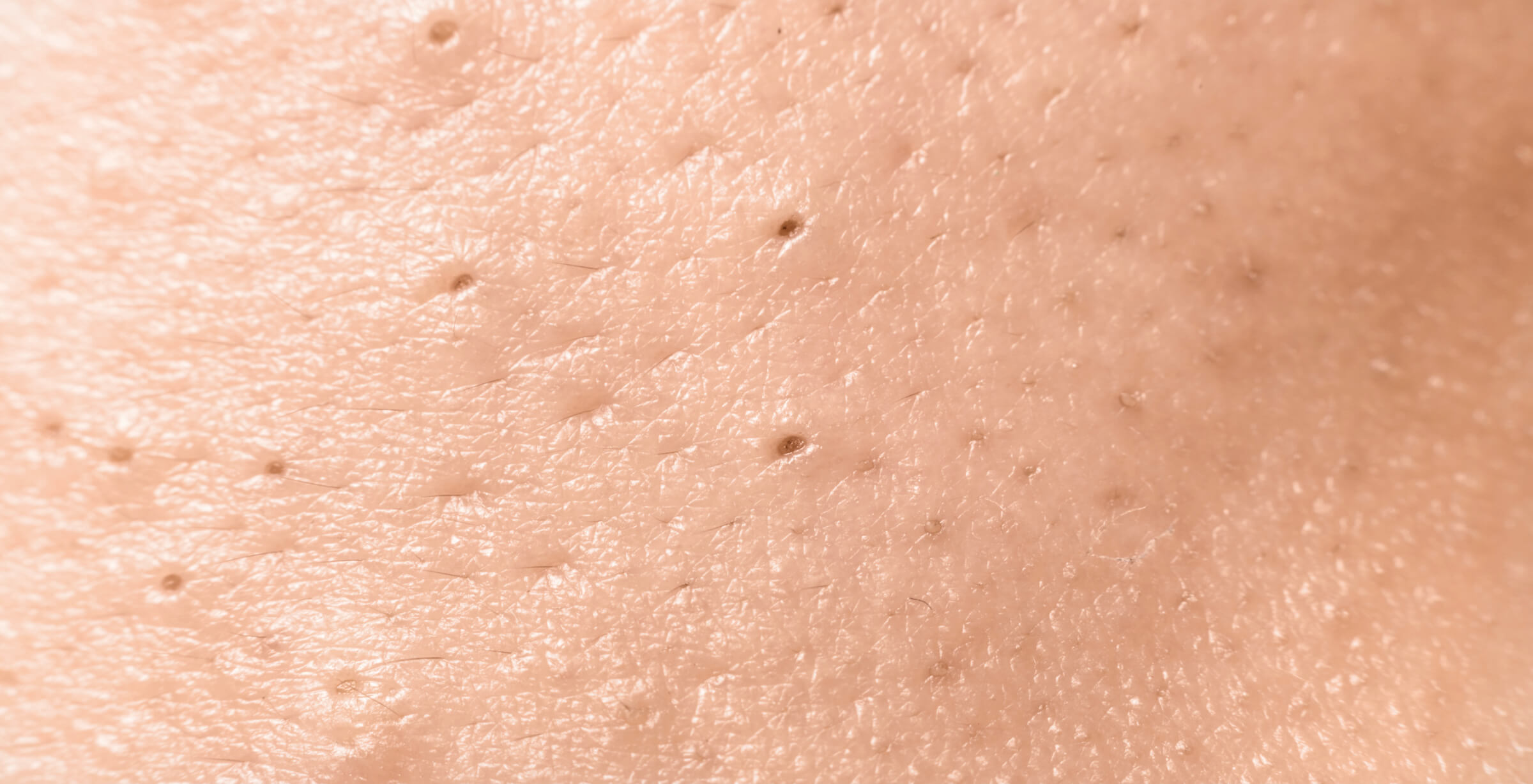 הסרת קומודונים ללא לחיצה – האם זה אפשרי? 2 mitesser entfernen gesicht frau was hilft gegen mitesser1 הסרת קומודונים ללא לחיצה – האם זה אפשרי?