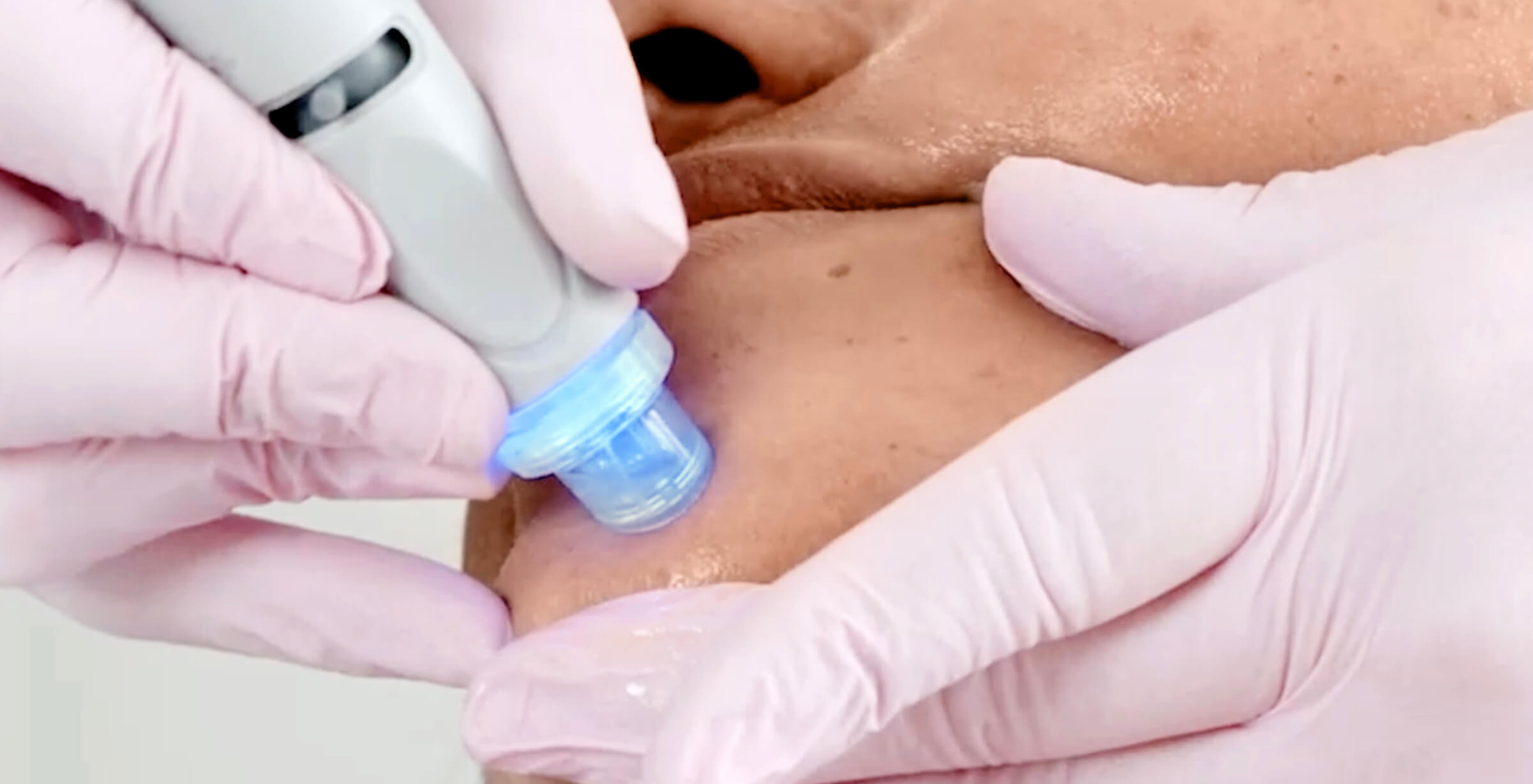 הסרת קומודונים ללא לחיצה – האם זה אפשרי? aquafacial behandlung mitesser entfernen gesicht frau was hilft gegen mitesser1 הסרת קומודונים ללא לחיצה – האם זה אפשרי?