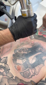 קאבר אפ לקעקוע או הסרת קעקועים בלייזר - מה עדיף? 