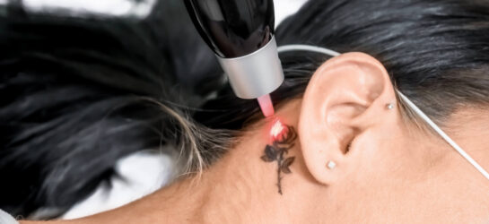 קאבר אפ לקעקוע או הסרת קעקועים בלייזר - מה עדיף?