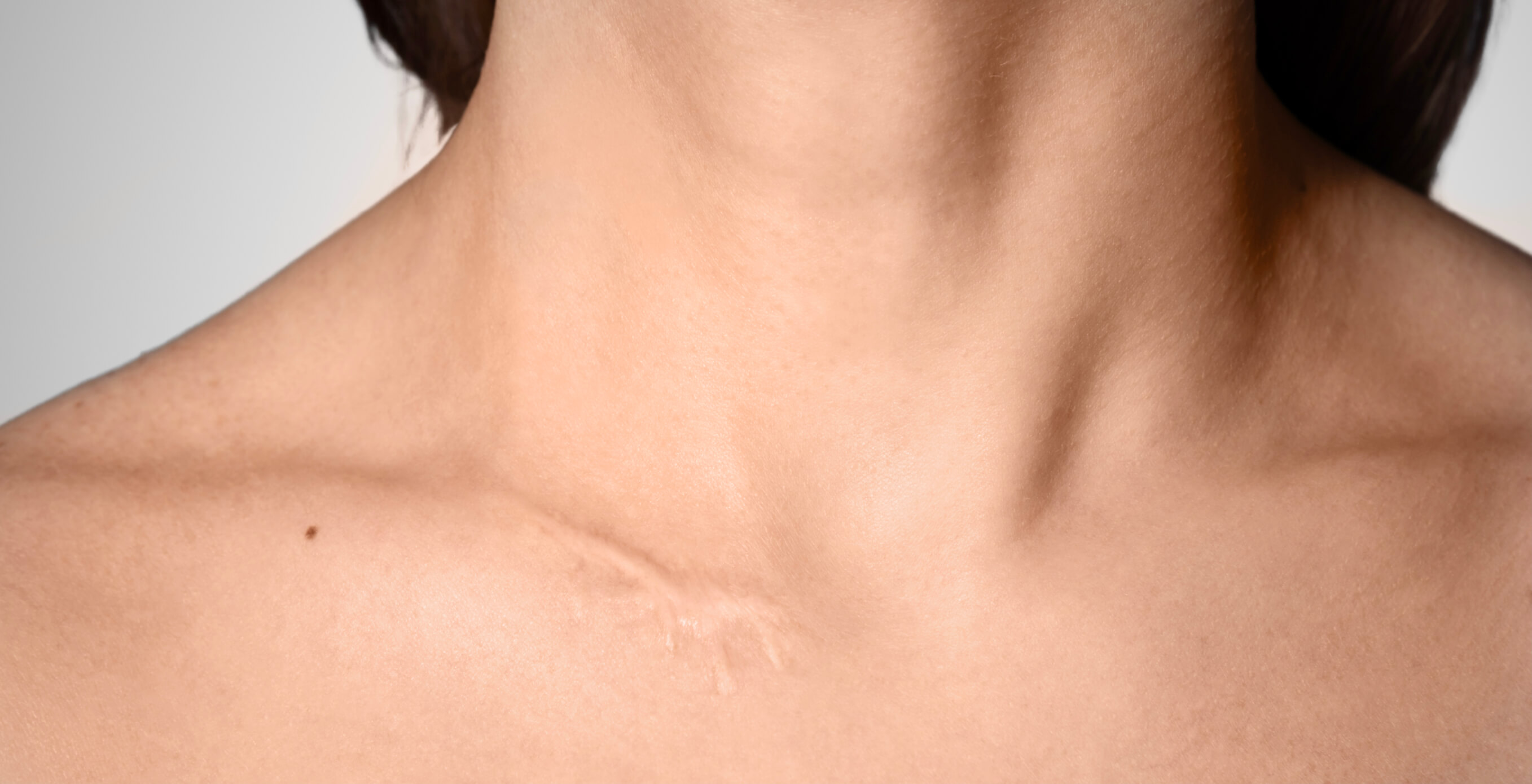 קעקוע על צלקת? כל מה שאתם צריכים לדעת Schluesselbein narbe tattoo ueber narben loesung dermacare wien1 קעקוע על צלקות? כל מה שאתם צריכים לדעת