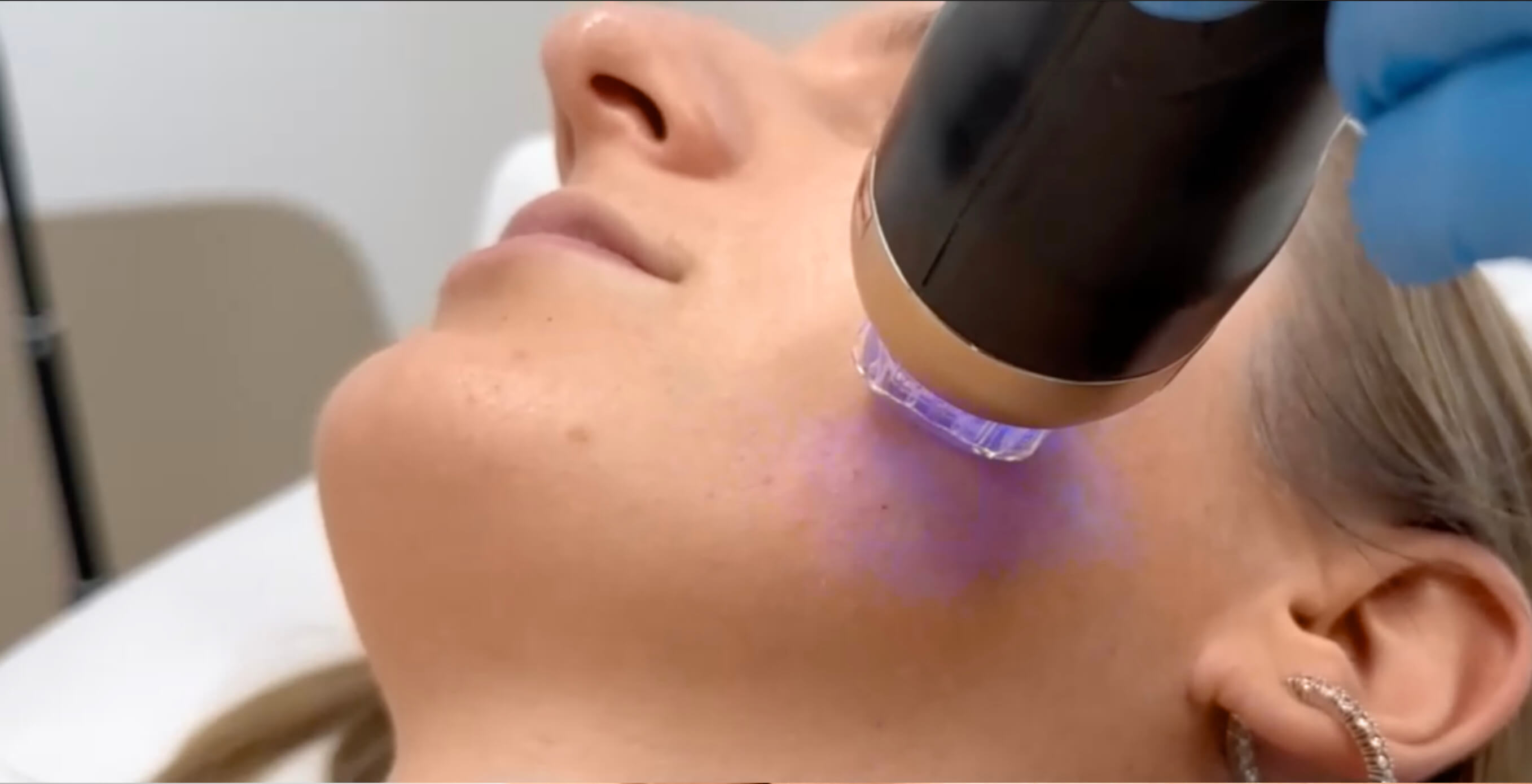 איך להיפטר מנקבוביות גדולות ושחורים? dermacare wien aehnlich morpheus8 behandlung radiofrequenz microneedling frau1 איך להיפטר מנקבוביות גדולות ושחורים?