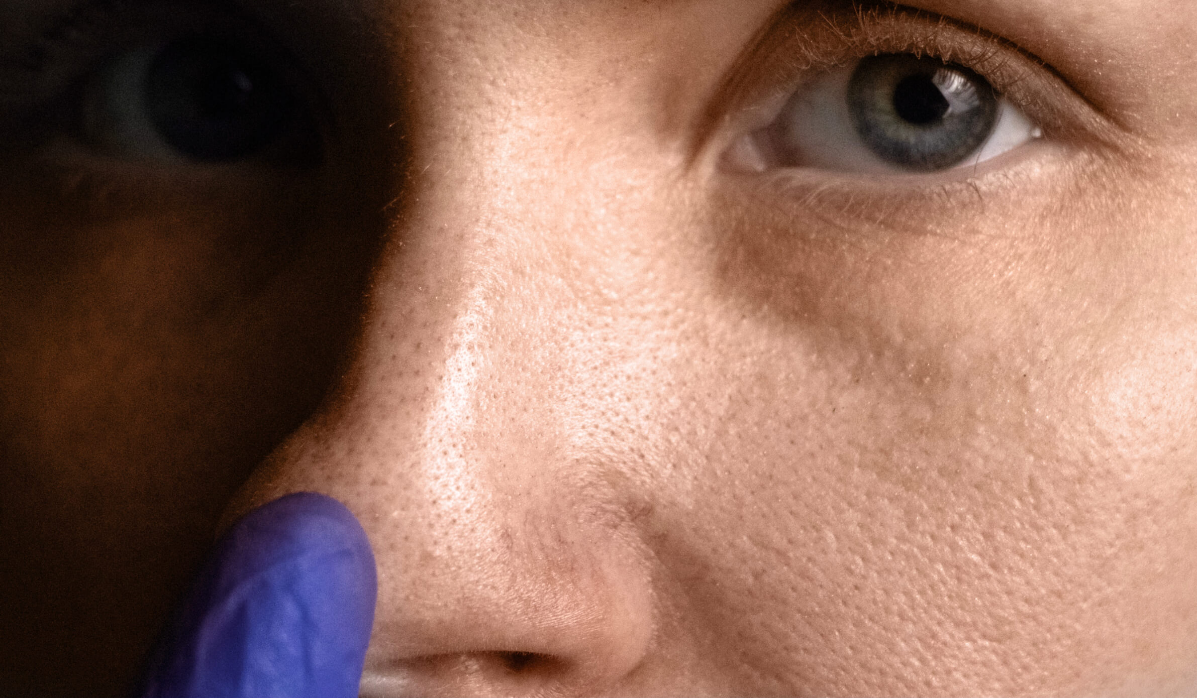 איך להיפטר מנקבוביות גדולות ושחורים? grosse Poren mann nase1 איך להיפטר מנקבוביות גדולות ושחורים?