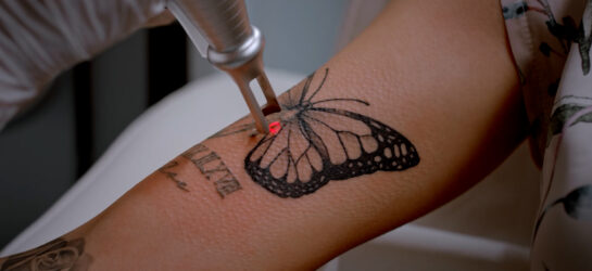 הסרת קעקועים עלות: כמה זמן לוקח וכמה זה עולה? | מחיר לפי גודל