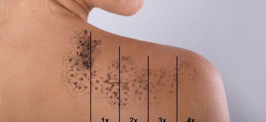 תהליך הסרת קעקוע בלייזר: מה קורה בכל שלב, כמה זמן זה לוקח ומה המחיר? 82113a616d15b1c3339338ed7e0dec4d תהליך הסרת קעקוע בלייזר: מה קורה בכל שלב, כמה זמן זה לוקח ומה המחיר?